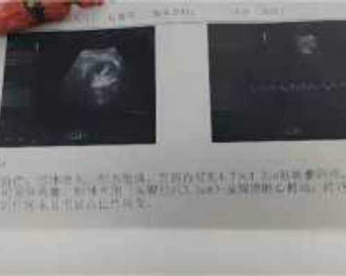 中国代孕一般多少钱,婴儿湿疹是热出来的吗，儿科医*教你区别